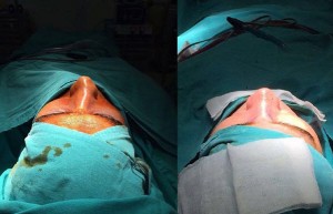 before-after