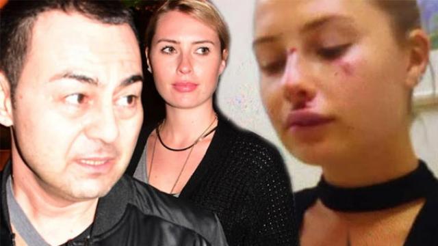 Serdar Ortaç’ın eşi Chloe Loughnan, Miami’de kaldırımdan düşerek yüzünün bu hale geldiğini söyledi. Ancak iddialara göre İrlandalı model darp edildi.